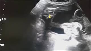 Fetal Anomaly scan Omphalocele with other associated anomalies di watch and subscribe us [upl. by Eibber]