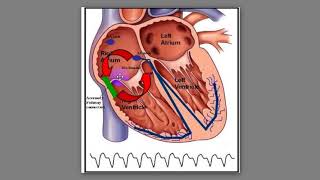 72 Phân biệt cơn AVNRT và Orthodromic AVRT [upl. by Hgielrebmik]