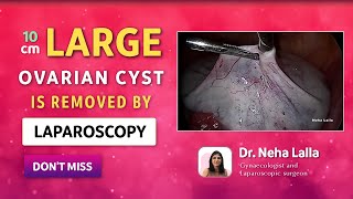 2022 Ovarian Cyst Signs and Symptoms  Scarless Laparoscopic Treatment  Dr Neha Lalla [upl. by Aicat]