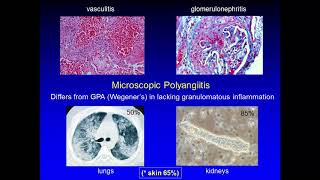 New and Emerging Treatments in Cutaneous Vasculitis [upl. by Nynahs]