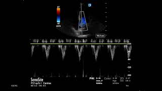 How to Measure LVOT VTI [upl. by Ahsircal]