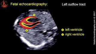 Fetal echocardiography at 1113 weeks Technique of Early Heart Scan [upl. by Maire330]