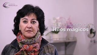 Hilos Tensores antes y después  Experiencia Clínica Menorca [upl. by Akoek]