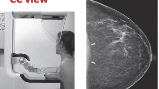 week 21 breast imaging [upl. by Aidua]