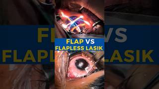 Flap VS Flapless Lasik [upl. by Aettam741]