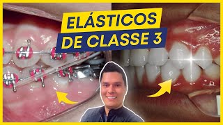 7 CUIDADOS AO USAR OS ELÁSTICOS DE CLASSE 3 [upl. by Culhert937]