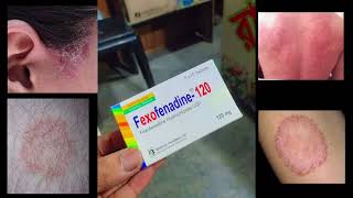 Allegra Tablet Fexofenadine 120 mg Use Dose Side Effects and Price in bengali [upl. by Ahsiuqel]