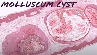 Molluscum quotCystquot cystic molluscum contagiosum pathology dermpath dermatology dermatopathology [upl. by Phillip616]