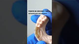 Puente de Zirconio estratificado con cerámica y cerámica de encíaimpresión dental 3d [upl. by Raphaela]