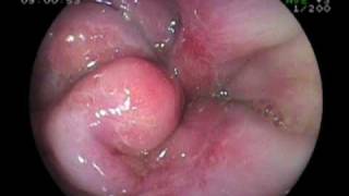 Esophageal Erosion Esophageal Varice Stomach Ulcer and Duodenitis [upl. by Siraval]