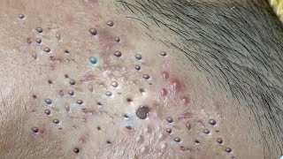 Big Cystic Acne Blackheads Extraction Blackheads amp Milia Whiteheads Removal Pimple Popping  3370 [upl. by Benioff148]