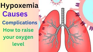 Hypoxemia  Symptoms causes complications  How to raise oxygen level in the body [upl. by Demaggio707]