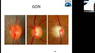 Glaucoma amp NeuroOphthalmology Webinar [upl. by Esila]