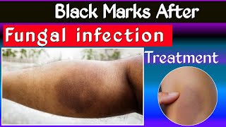 फंगल इन्फेक्शन काला पड़ गया है कैसे करे सही  fungal infection black marks on skin [upl. by Karleen]