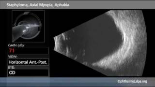 Staphyloma Axial Myopia Aphakia [upl. by Drofkcor]