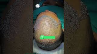 Hair Transplant Result  BIGFUE Hair Transplant Before amp After  2800 Grafts Hair Transplant Result [upl. by Sima100]