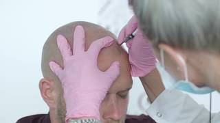 Micro Scalp Pigmentation Forget Hair Loss with Vinci Hair Clinic [upl. by Okihcas]