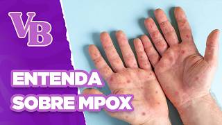 MPOX Causas e tratamentos  Você Bonita 21082024 [upl. by Eessej]