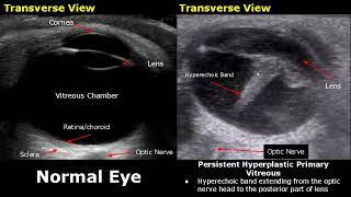 Eye Ultrasound Normal Vs Abnormal Images  CataractRetinal DetachmentGlobe RuptureChoroid USG [upl. by Sunev]