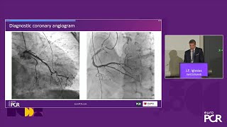 Revisiting thrombus aspiration in STEMI with continuous power aspiration system  EuroPCR [upl. by Shari]