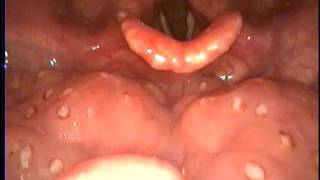 舌扁桃腺 lingual tonsil purulent thrombi Dr Ken Liao LIU [upl. by Laehcym853]