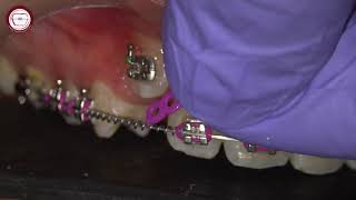 Dracula canine traction in orthodontics [upl. by Itisahc999]