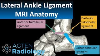 MRI Anatomy of lateral ankle ligaments [upl. by Enyalb546]