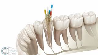 Endodontie  Wurzelbehandlung  City Dental Clinic Bratislava [upl. by Elocim]