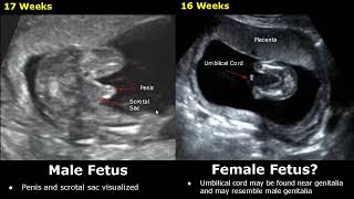 Fetal Gender Determination On Ultrasound  Determining The Sex Of A Baby On USG BoyGirl [upl. by Rehpitsirhc]