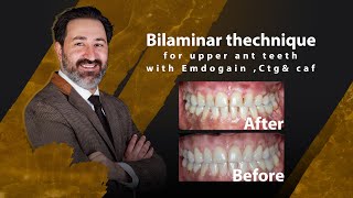 Bilaminar thechnique for upper ant teeth with Emdogain Ctgamp caf  Dr Amirreza Moayer [upl. by Reivaxe623]