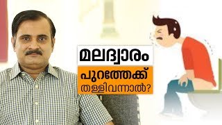 Rectal Prolapse Surgery Treatment amp Recovery  മലദ്വാരം പുറത്തേക്ക് തള്ളിവന്നാല്‍ [upl. by Juliano983]