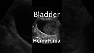 Bladder Hematoma pocus ultrasound emergencymedicine urology [upl. by Aidnic126]