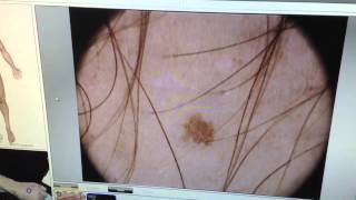 microfinder  microderm dermoscopy  diagnosis [upl. by Tamqrah]