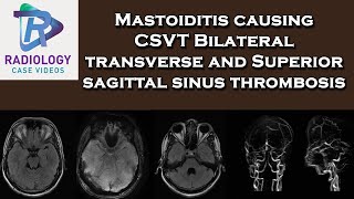 Mastoiditis causing CSVT Bilateral transverse and Superior sagittal sinus thrombosis [upl. by Orian]