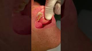 Parotid gland sialolithiasis dentist hospital dentalstudent students dentistryworld [upl. by Dickman]