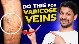 VARICOSE VEINS explained under 10 minutes  Saurabh Bothra Yoga [upl. by Ransell658]