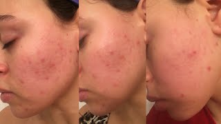 PostAccutane Skin Care Routine amp Managing Dryness Using Topical Tretinoin RetinA in Under 4 Min [upl. by Vatsug]