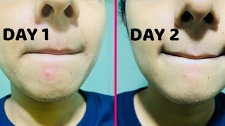 How to remove PIMPLES Overnight  Pimples removal Naturally Before and After [upl. by Ahsennod]