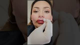 👄 Estos labios que  viral dentista dentalcare odontologia [upl. by Gavra]