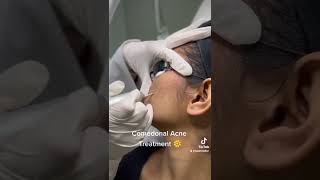 Comedonal Acne Treatment by CO2 laser [upl. by Yllet]