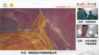 Laparoscopic left hemicolectomy 左半结肠癌根治术 [upl. by Offen195]