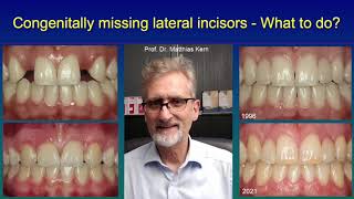 Congenitally missing lateral incisors  What to do [upl. by Pournaras]