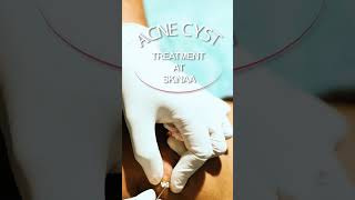 Effective Acne Cyst Treatment at Skinaa  Clear Skin Solutions by Top Dermatologists [upl. by Beshore]