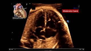 2022 Fetal Echocardiography Normal and Abnormal Hearts  A Video CME Teaching Activity [upl. by Ocnarf]