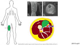 Soft Tissue Sarcoma [upl. by Eirena70]