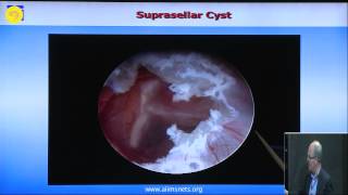 ETV and endoscopic intraventricular cyst management [upl. by Kinzer]