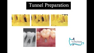 TUNNEL PREPARATIONTREATMENT OF FURCATION INVOLVEMENTDR ANKITA KOTECHADENTAL STUDIES SIMPLIFIED [upl. by Brigette]