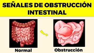 OBSTRUCCIÓN INTESTINAL Señales de Alerta Que Nunca Debes Ignorar [upl. by Ennahtebazile]