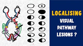 LESIONS OF VISUAL PATHWAY  SCOTOMAS EXPLAINED Junctional scotoma HOMONYMOUS HEMIANOPIA [upl. by Hayman]