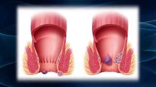 Hurting From Hemorrhoids [upl. by Elacim]